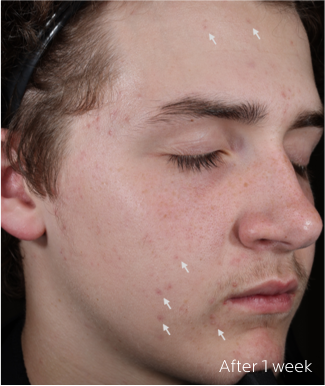 Effaclar-BPO-MTT-Before-And-Afters-Subject-27-Slider-1-Week