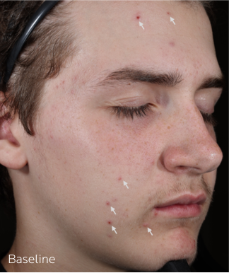 Effaclar-BPO-MTT-Before-And-Afters-Subject-27-Slider-Baseline