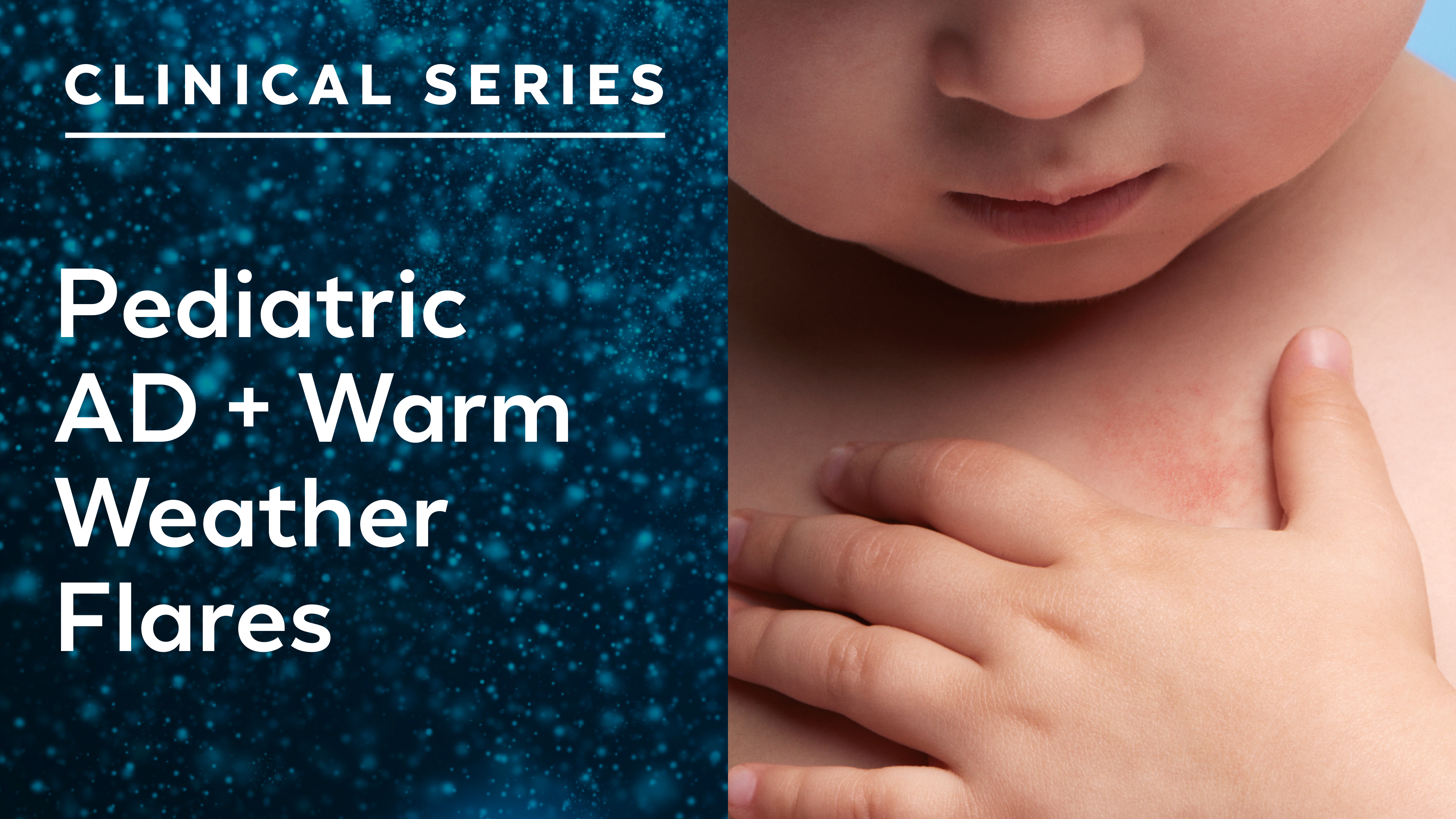 Pediatric atopic dermatitis